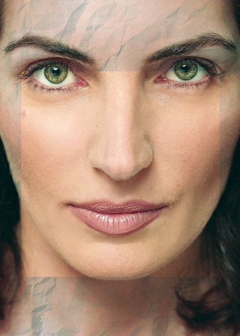 Profhilo® Structura